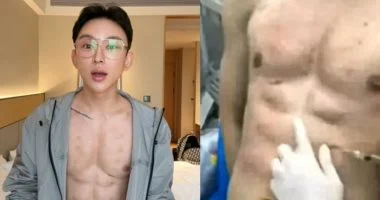 مؤثر صيني يدفع 560 ألف دولار لعضلات بطن وهمية بحقن الهيالورونيك